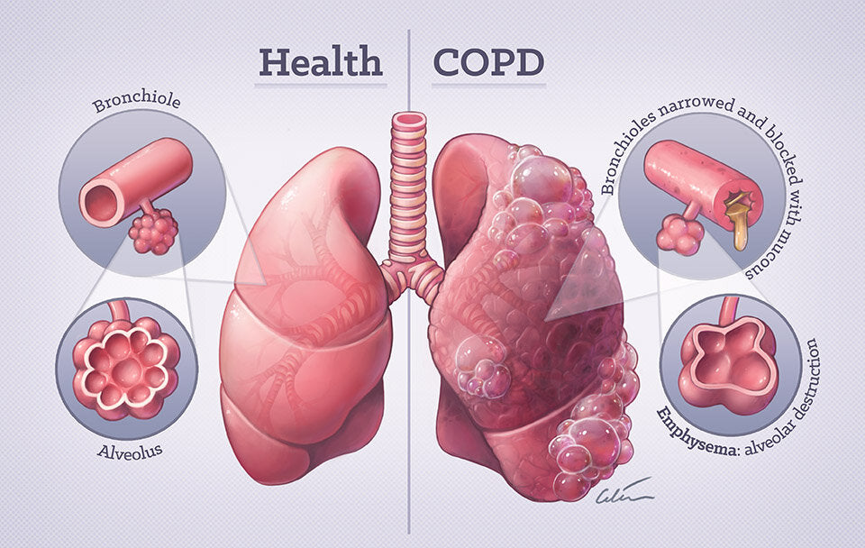 What Symptoms are Associated with Stage III COPD?——OSITO Oxygen Concentrator Tips