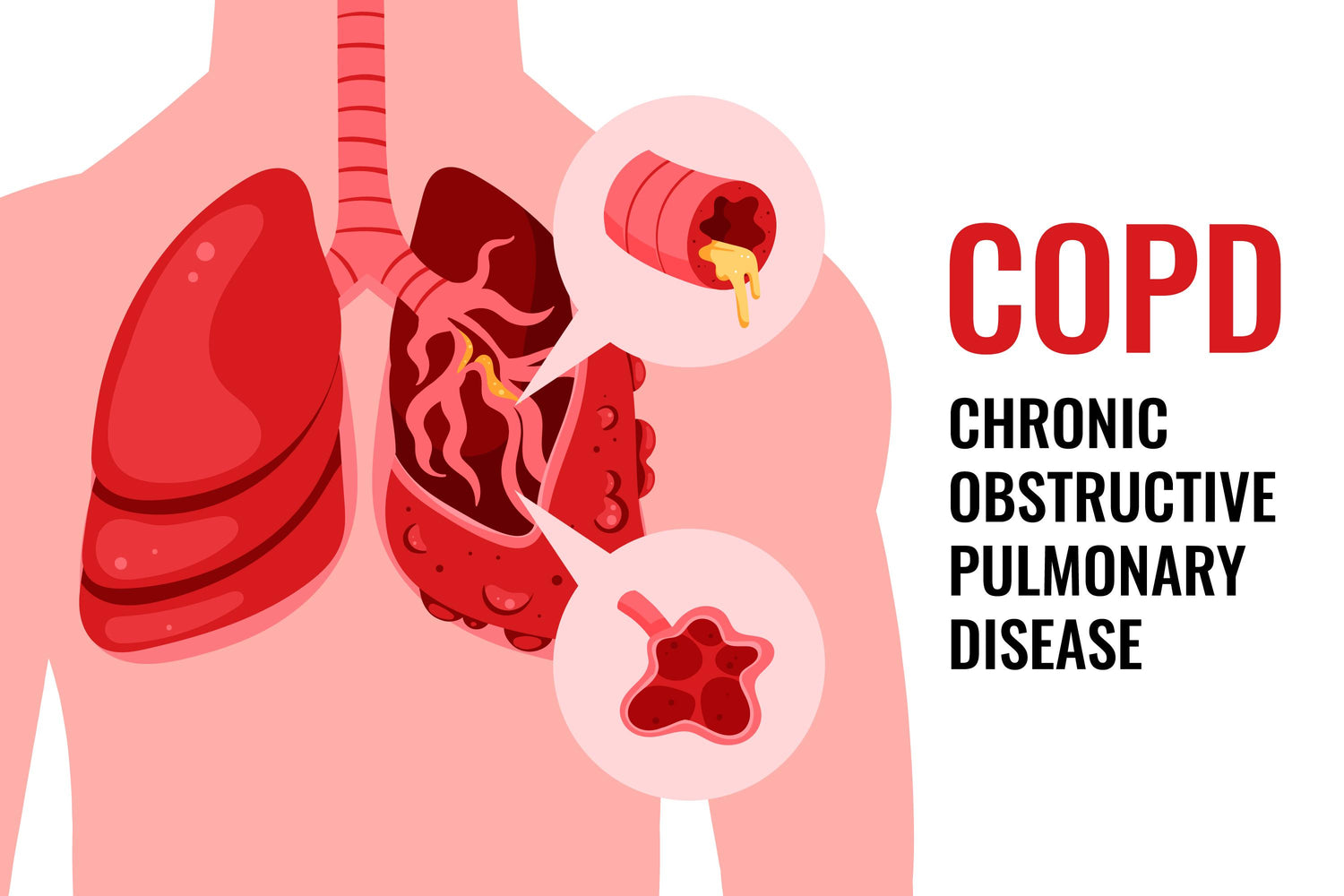 What Symptoms are Associated with Stage III COPD?——OSITO Oxygen Concentrator Tips